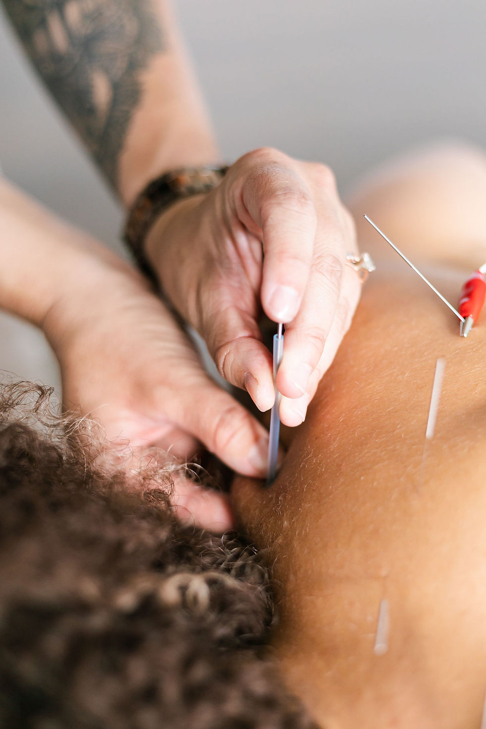 Dry Needling Charleston SC