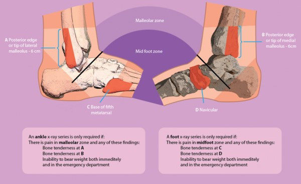 ottawa ankle at clinical physio st ives