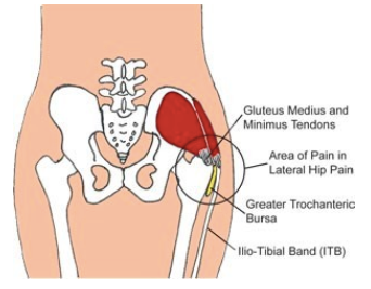 hip bursitis