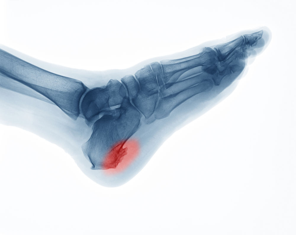 Plantar Fasciitis Heel Spurs And Cortisone Injections