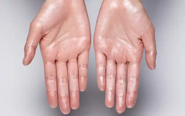 Hyperhidrosis treatment