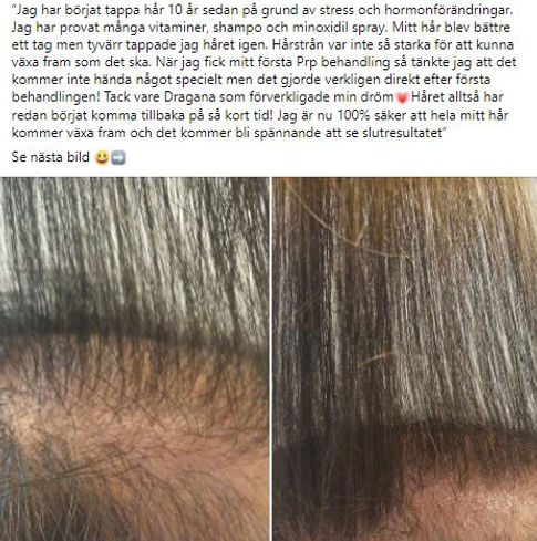 Omdöme från kund efter PRP-behandling.
