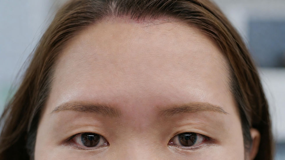 Brow Lift Procedure Los Angeles: A Step-by-Step Journey from Consultation to Final Results