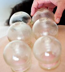 Cupping
