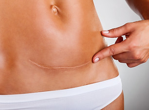 IGBeauty_laser_scar_revision.jpg