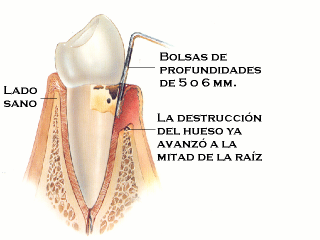 Periodontitis moderada