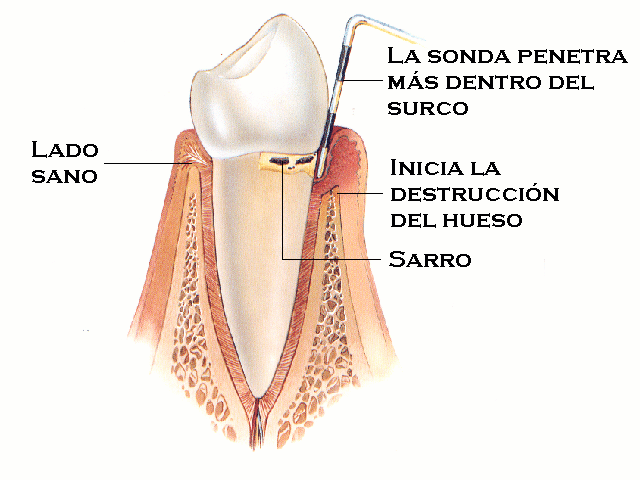 Periodontitis leve