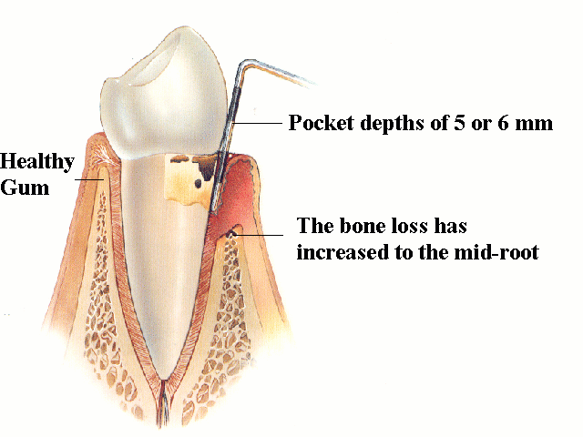 Moderate Periodontitis
