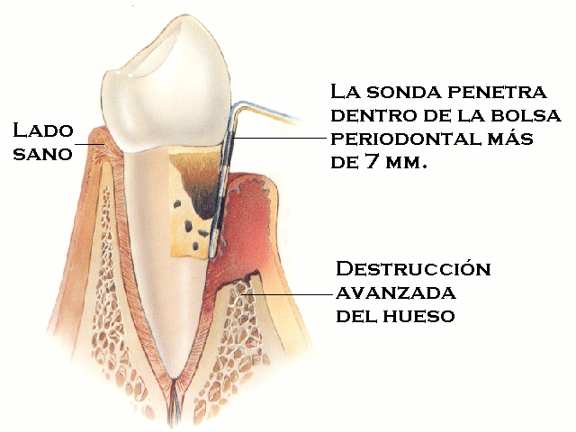 Periodontitis avanzada