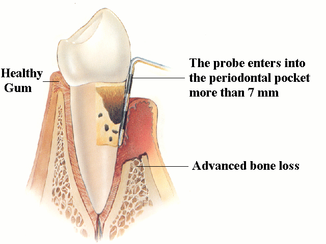 Advanced Periodontitis