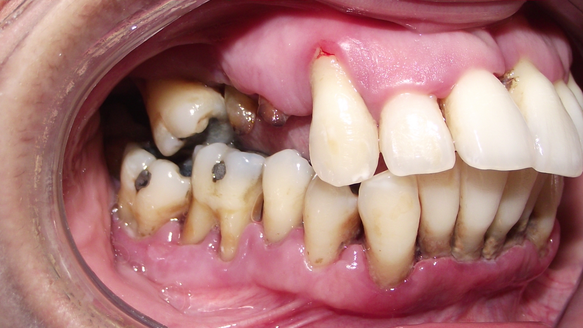 Periodontitis avanzada