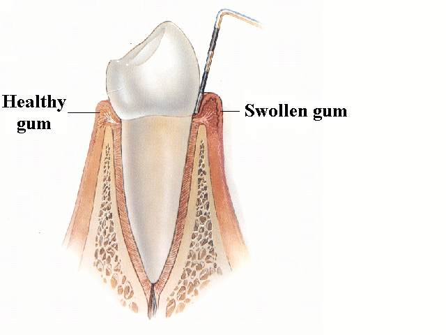 Gingivitis