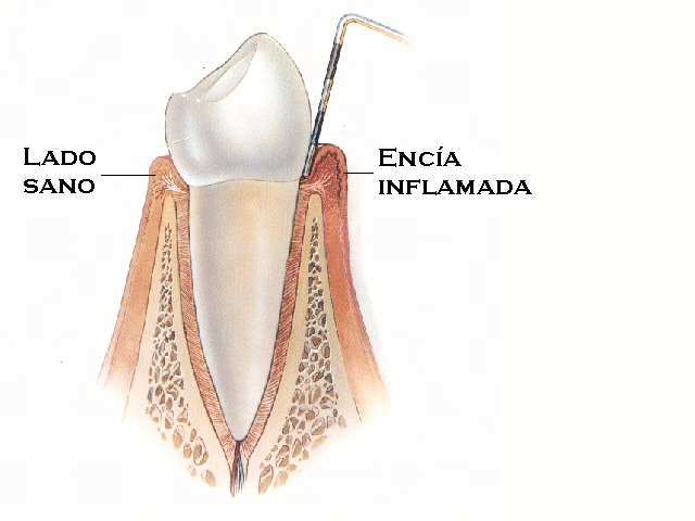 Gingivitis