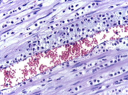 Margination_of_neutrophils_in_acute_infl