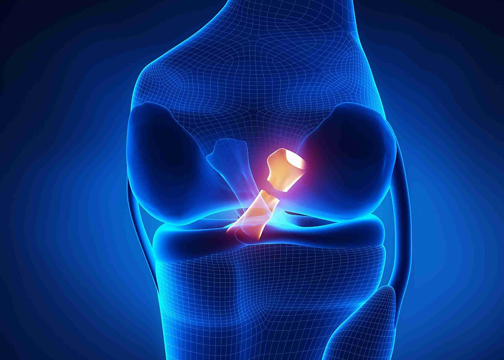 Pcl Knee Injuries - Posterior Cruciate Ligament (PCL)