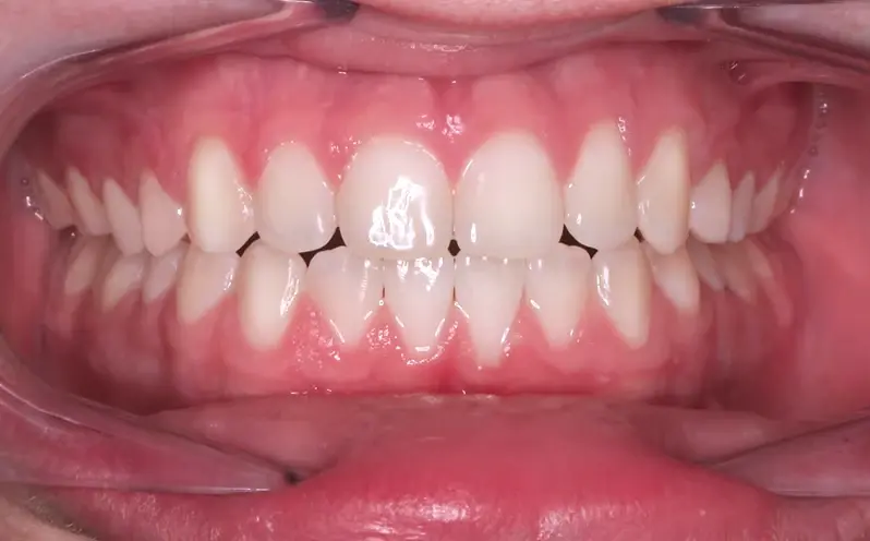 Invisalign2_After.webp