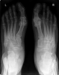 xray foot.jpeg