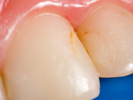 Types of Teeth Stains, What Causes Them, and How to Treat Them