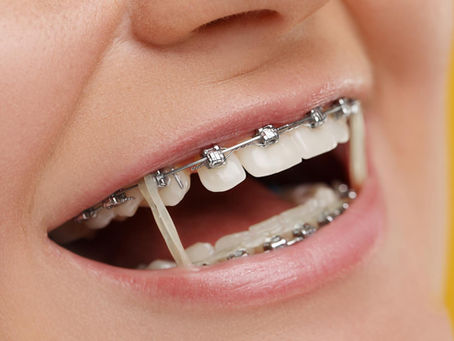 How many hours a day do I need to wear rubber bands for braces?