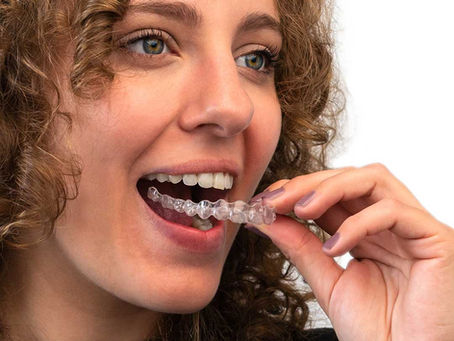 Clear Aligners: An Alternative to Braces for Adults