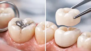 Tooth Filling vs Crown for a Damaged Tooth