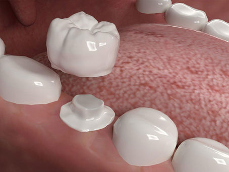 how many years does dental crowns last?