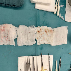 Fordyce Drüsen im Intimbereich: Symptome, Ursachen, Diagnose und Behandlung mit der Mikrostanzen-Technik