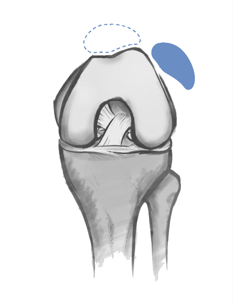 The Dubai Hip and Knee Institute (DHKI) - Dr Hervé Ouanezar