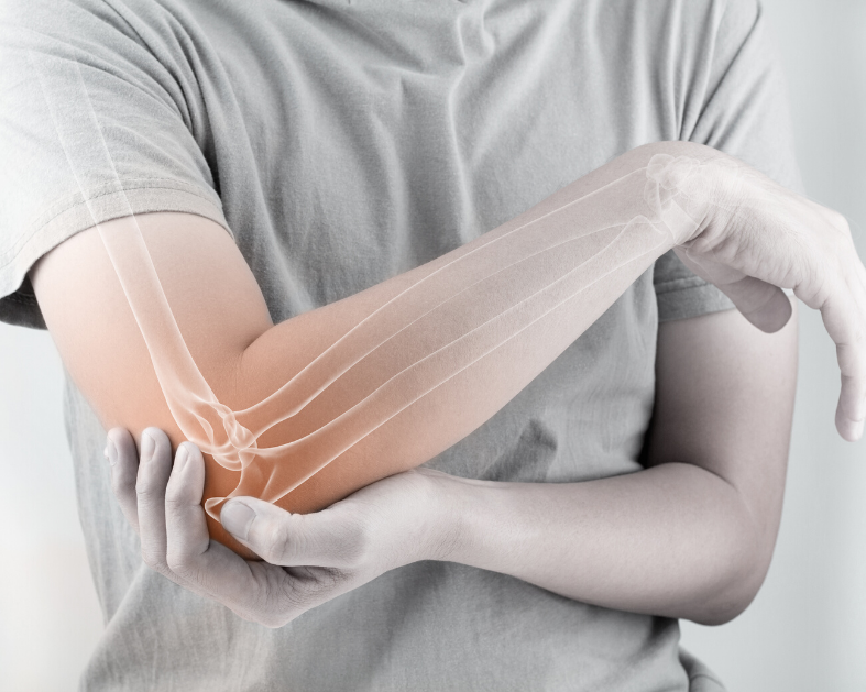 Osteoporose nos celíacos