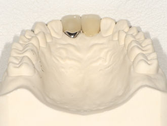 メタルボンド・オールセラミック