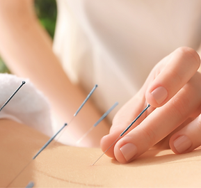 Acupuncture therapist putting needles into someones back as part of a therapy session 