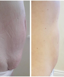 Radio Frequency Skin Tightenin Before and After