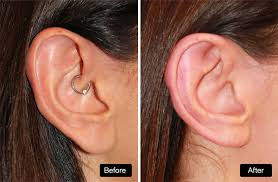 What Is Ear Reshaping Surgery and How Does It Work?