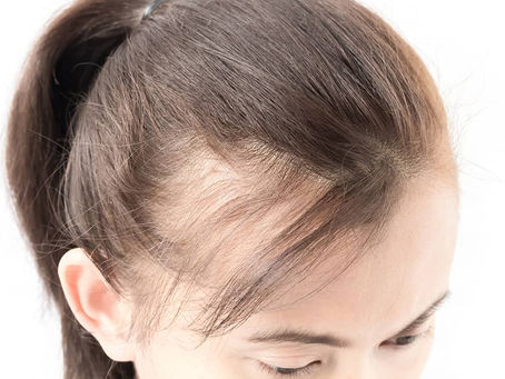 What Is the Best Hair Loss Treatment Today?