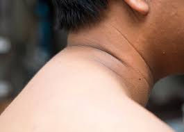What Causes Dark Neck and How Can Whitening Treatments Help?