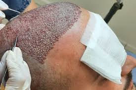 Hair Transplant vs Other Hair Loss Treatments