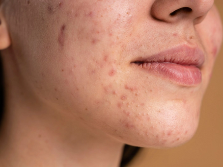 What Is Melasma and How Is It Treated?