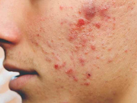 What Is the Best Acne Treatment for Sensitive Skin?