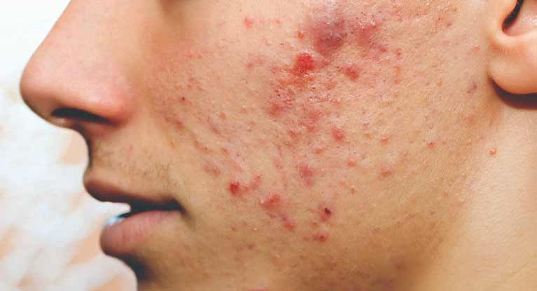 Acne Treatment In Dubai(علاج حب الشباب في دبي)