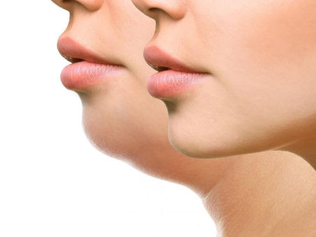 كل ما تحتاج لمعرفته حول تصغير الذقن في دبي