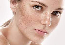 Skin Pigmentation Treatment in Dubai(علاج التصبغات في دبي)
