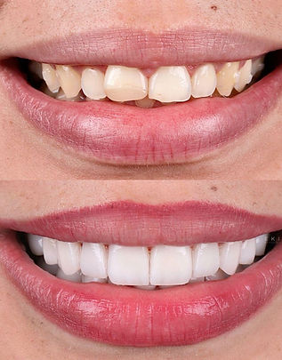 Smile makeover.jpeg