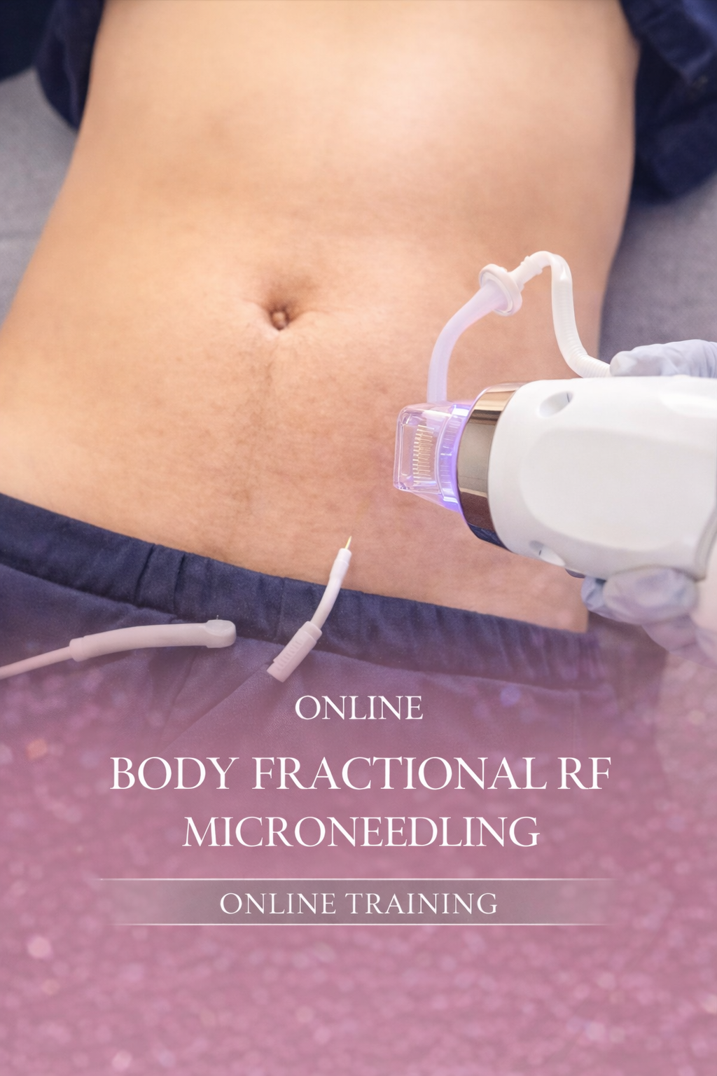 Online Body Fractional RF Microneedling- Secret microneedling