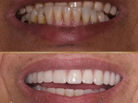 Reabilitação Protética para Mordida Cruzada ou Protrusão (Classe III): Quando os Dentes de Baixo Ficam à Frente