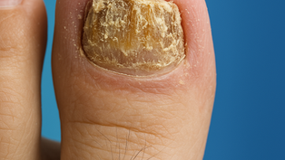 Kerassentials oil for nail fungus treatment