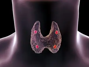 Entendendo o Hiperparatireoidismo: Causas, Sintomas, Diagnóstico e Tratamento