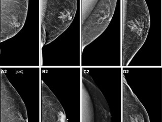 Mammograms for Men