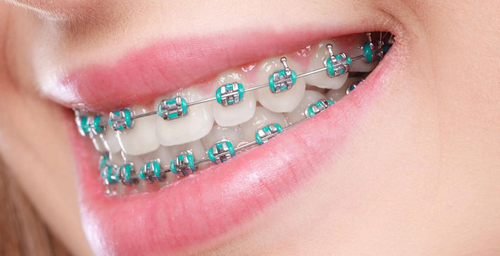 Orthadontics Dental Plus Tauranga.jpg