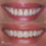 Replacement Veneers