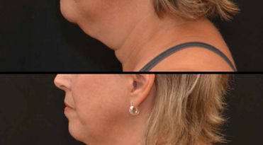 Submental after 2 treatments of CoolSculpting Elite